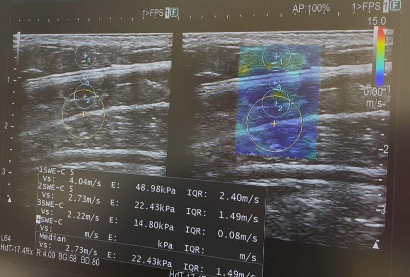 Ultrasound elastography screen showing a B-mode image beside a colour map, with circular regions of interest and shear wave speed values